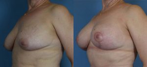 Breast Lift Before & After Patient Miniature Set