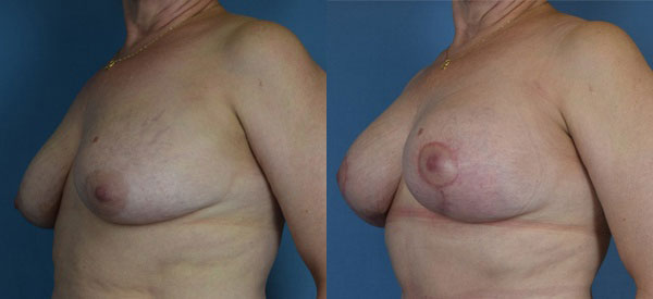 Photo of the patient’s body before & after the Breast Lift surgery. Set 2: Patient 4