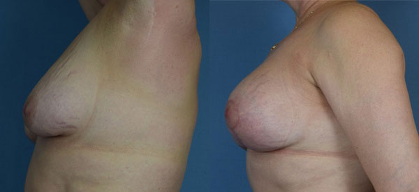 Photo of the patient’s body before & after the Breast Lift surgery. Set 3: Patient 4