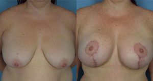Breast Lift Before & After Patient Miniature Set
