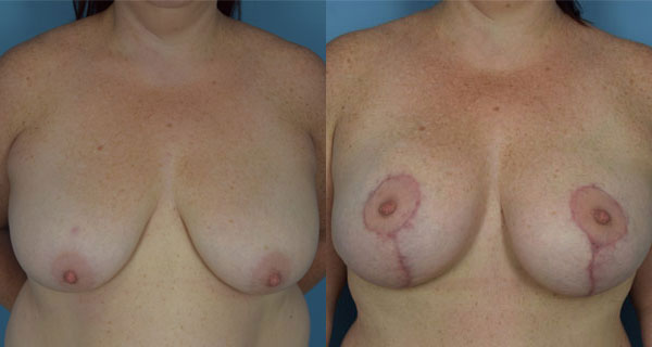 Photo of the patient’s body before & after the Breast Lift surgery. Set 1: Patient 5