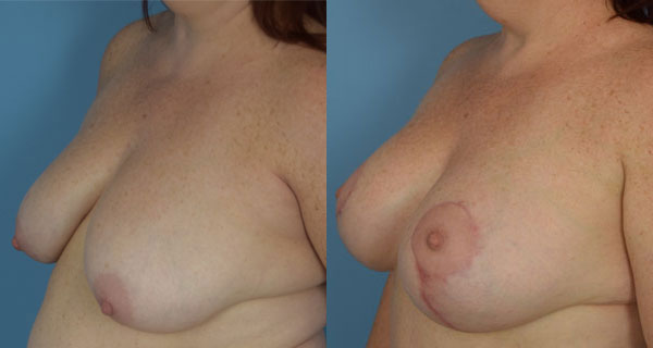 Photo of the patient’s body before & after the Breast Lift surgery. Set 2: Patient 5