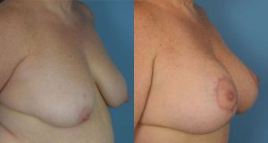 Breast Lift Before & After Patient Miniature Set