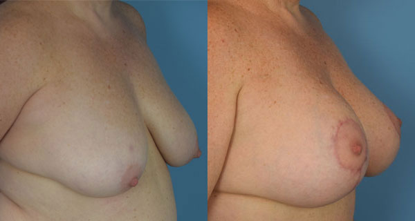 Photo of the patient’s body before & after the Breast Lift surgery. Set 3: Patient 5