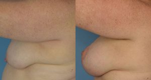 Breast Lift Before & After Patient Miniature Set