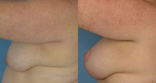 Photo of the patient’s body before & after the Breast Lift surgery. Set 4: Patient 5