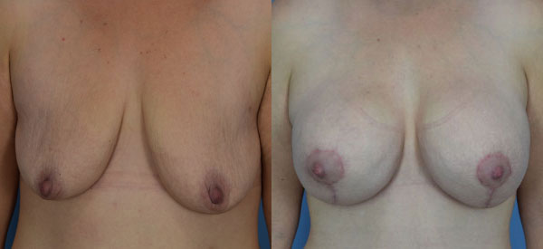 Photo of the patient’s body before & after the Breast Lift surgery. Set 1: Patient 7