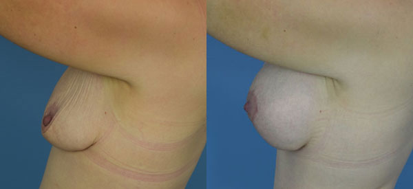 Photo of the patient’s body before & after the Breast Lift surgery. Set 2: Patient 7
