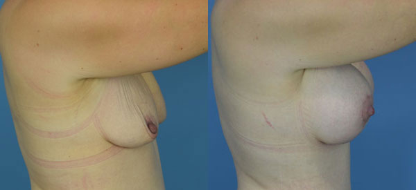 Photo of the patient’s body before & after the Breast Lift surgery. Set 3: Patient 7