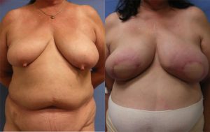 Breast Reconstruction Before & After Patient Miniature Set