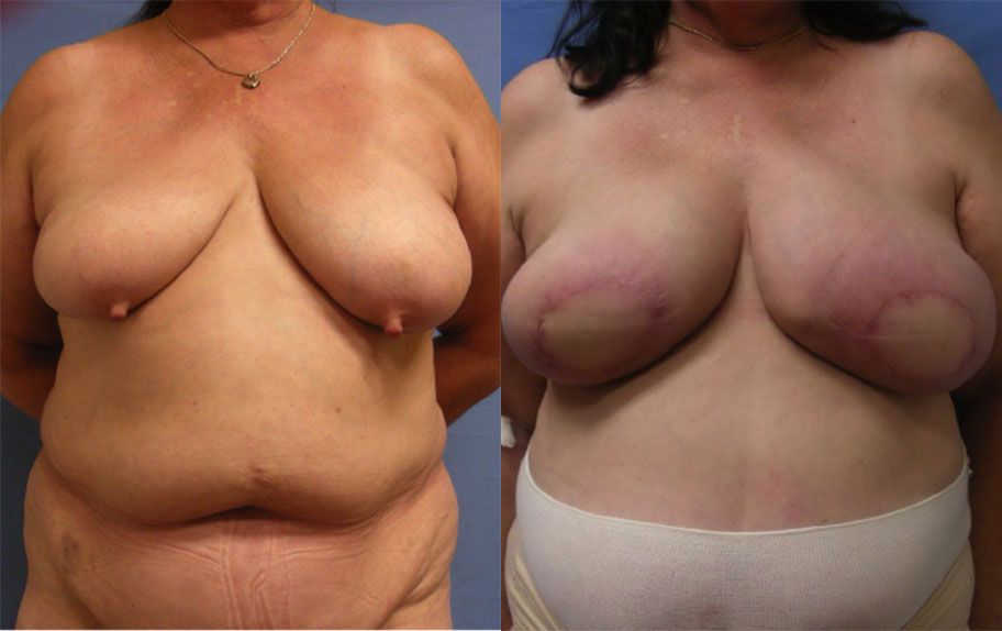 Photo of the patient’s body before & after the Breast Reconstruction surgery. Set 1: Patient 1