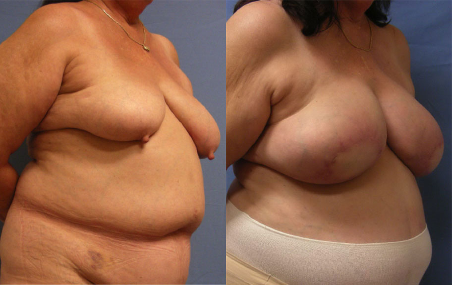 Photo of the patient’s body before & after the Breast Reconstruction surgery. Set 2: Patient 1
