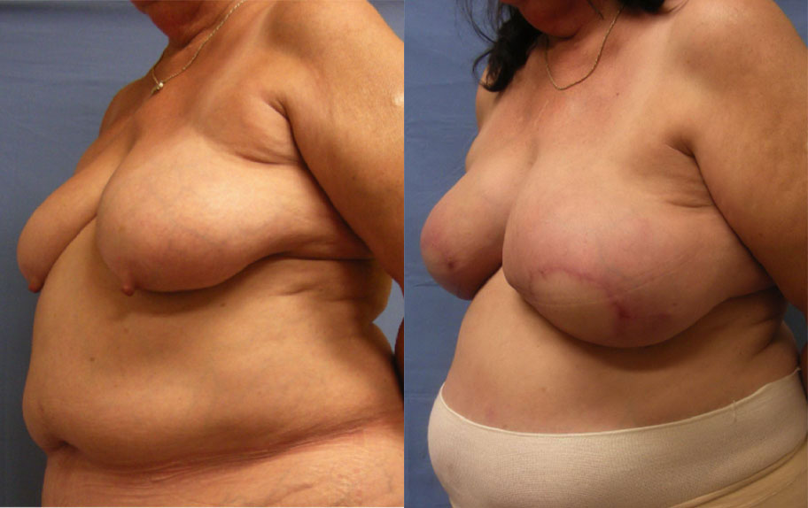 Photo of the patient’s body before & after the Breast Reconstruction surgery. Set 3: Patient 1