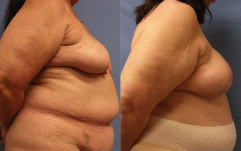 Photo of the patient’s body before & after the Breast Reconstruction surgery. Set 4: Patient 1