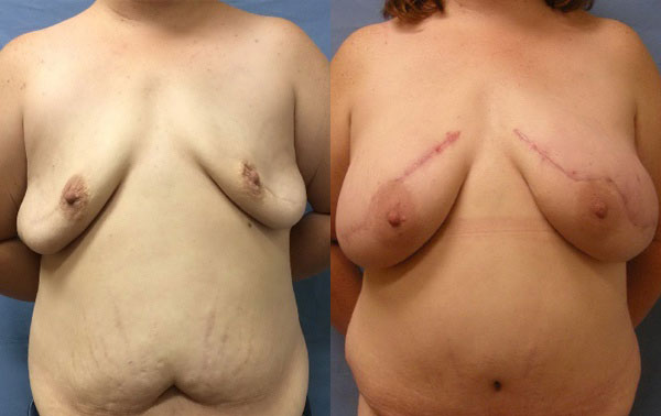 Photo of the patient’s body before & after the Breast Reconstruction surgery. Set 1: Patient 2