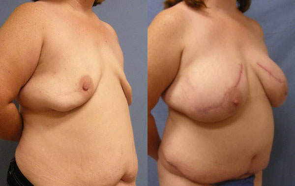 Photo of the patient’s body before & after the Breast Reconstruction surgery. Set 2: Patient 2