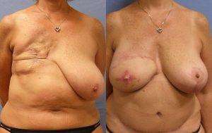 Breast Reconstruction Before & After Patient Miniature Set