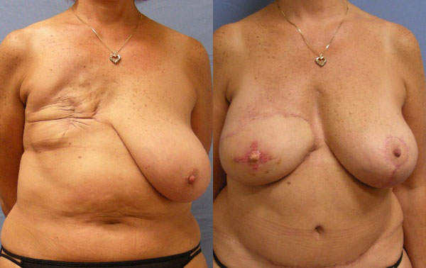 Photo of the patient’s body before & after the Breast Reconstruction surgery. Set 1: Patient 3
