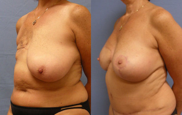Photo of the patient’s body before & after the Breast Reconstruction surgery. Set 2: Patient 3