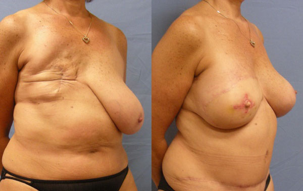 Photo of the patient’s body before & after the Breast Reconstruction surgery. Set 3: Patient 3