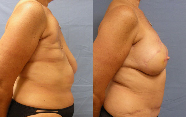 Photo of the patient’s body before & after the Breast Reconstruction surgery. Set 4: Patient 3