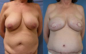 Breast Reconstruction Before & After Patient Miniature Set