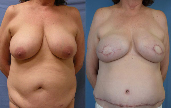 Photo of the patient’s body before & after the Breast Reconstruction surgery. Set 1: Patient 4