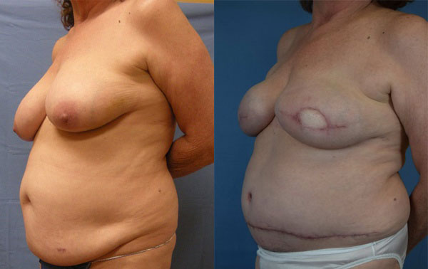 Photo of the patient’s body before & after the Breast Reconstruction surgery. Set 2: Patient 4