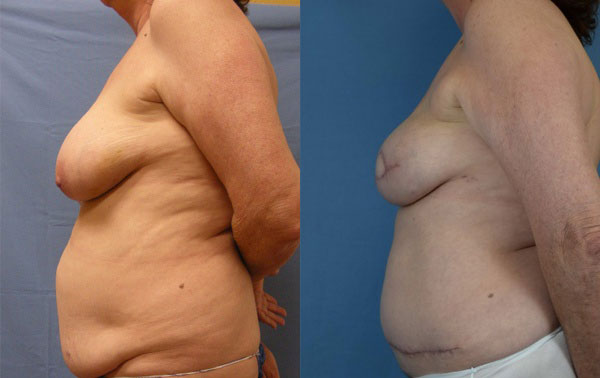 Photo of the patient’s body before & after the Breast Reconstruction surgery. Set 3: Patient 4
