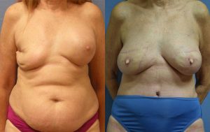 Breast Reconstruction Before & After Patient Miniature Set