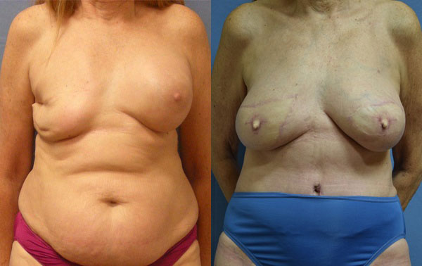 Photo of the patient’s body before & after the Breast Reconstruction surgery. Set 1: Patient 5