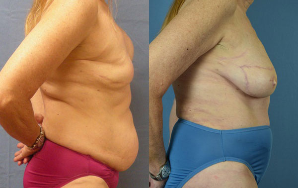 Photo of the patient’s body before & after the Breast Reconstruction surgery. Set 2: Patient 5