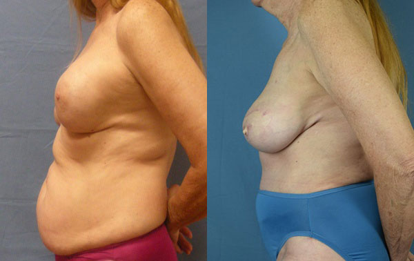 Photo of the patient’s body before & after the Breast Reconstruction surgery. Set 3: Patient 5