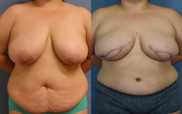 Photo of the patient’s body before & after the Breast Reconstruction surgery. Set 1: Patient 6