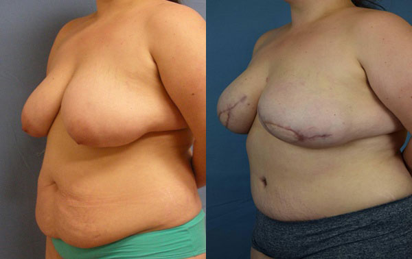 Photo of the patient’s body before & after the Breast Reconstruction surgery. Set 2: Patient 6