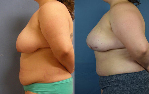 Photo of the patient’s body before & after the Breast Reconstruction surgery. Set 3: Patient 6