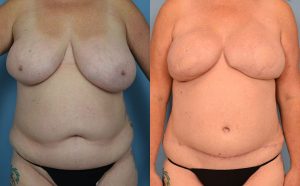 Breast Reconstruction Before & After Patient Miniature Set