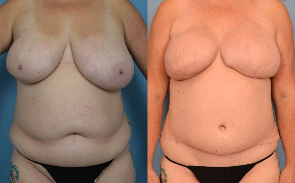 Photo of the patient’s body before & after the Breast Reconstruction surgery. Set 1: Patient 7
