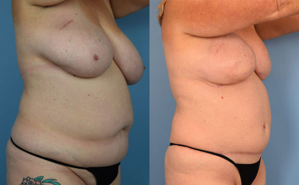 Photo of the patient’s body before & after the Breast Reconstruction surgery. Set 2: Patient 7