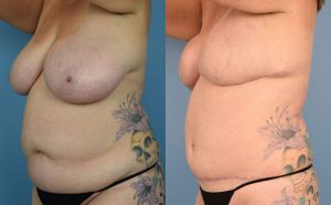 Breast Reconstruction Before & After Patient Miniature Set