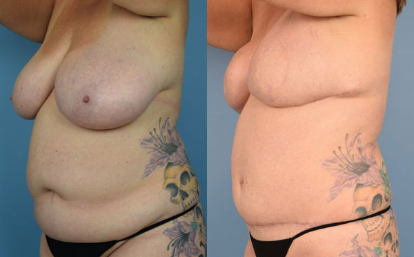 Photo of the patient’s body before & after the Breast Reconstruction surgery. Set 3: Patient 7