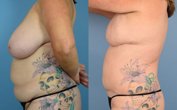 Photo of the patient’s body before & after the Breast Reconstruction surgery. Set 4: Patient 7