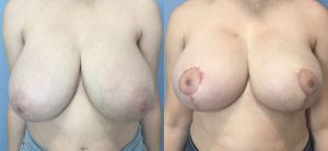 Breast Reduction Before & After Patient1