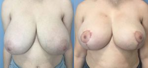 Breast Reduction Before & After Patient Miniature Set