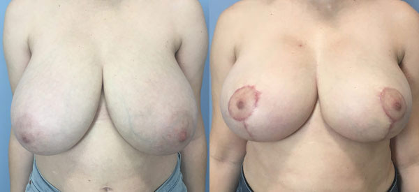 Photo of the patient’s body before & after the Breast Reduction surgery. Set 1: Patient 1