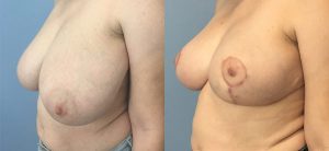 Breast Reduction Before & After Patient Miniature Set