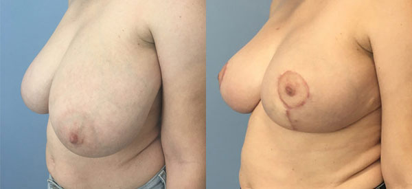 Photo of the patient’s body before & after the Breast Reduction surgery. Set 2: Patient 1