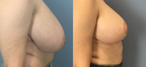 Photo of the patient’s body before & after the Breast Reduction surgery. Set 3: Patient 1