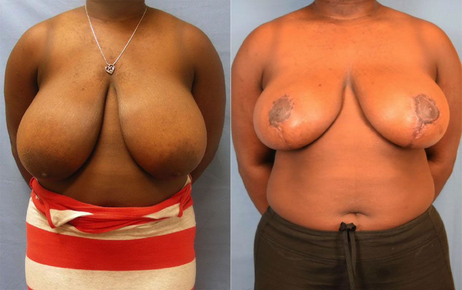 Photo of the patient’s body before & after the Breast Reduction surgery. Set 1: Patient 2