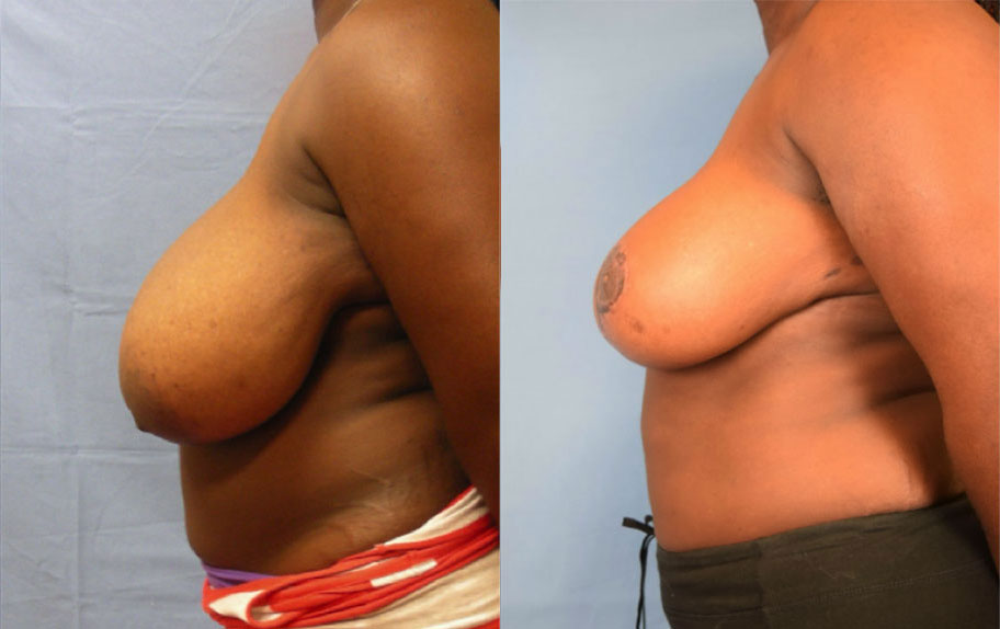 Photo of the patient’s body before & after the Breast Reduction surgery. Set 2: Patient 2